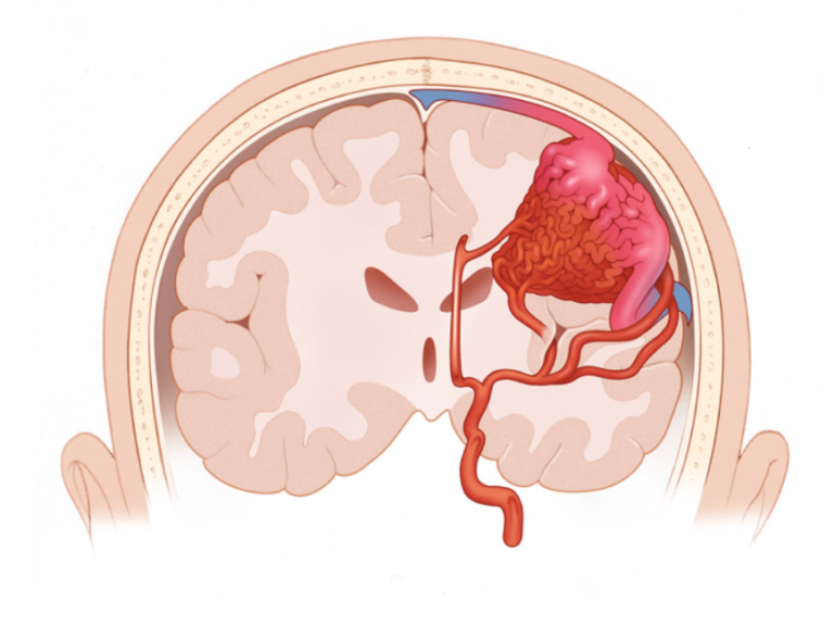 Arteriovenous Malformations - AANS/CNS Cerebrovascular Section