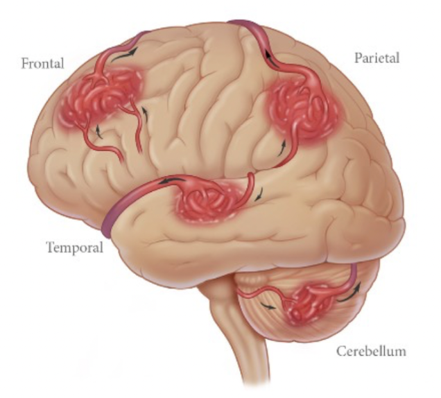 Arteriovenous Malformations - AANS/CNS Cerebrovascular Section