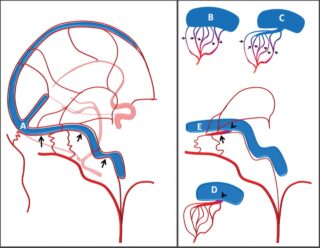 Arteriovenous Fistulas