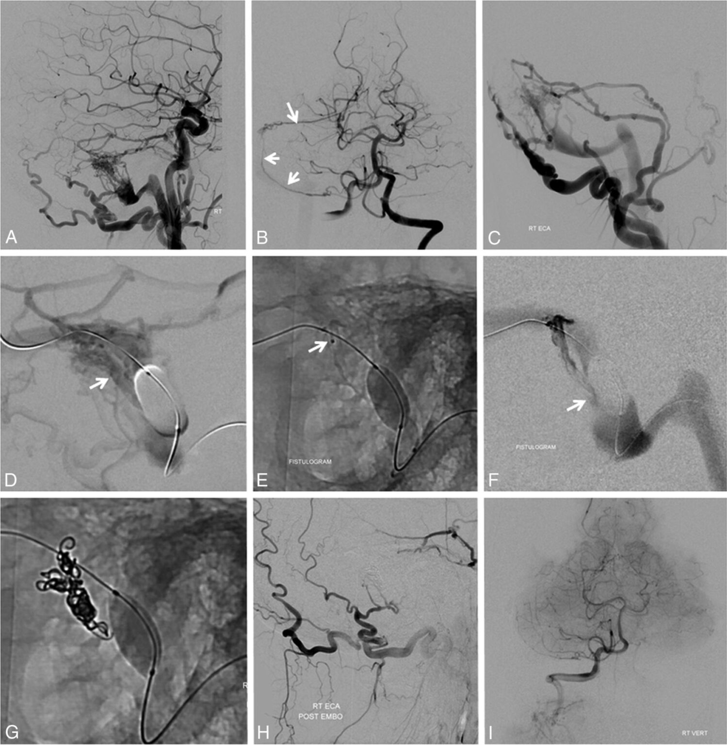 Arteriovenous Fistulas (AVF) - AANS/CNS Cerebrovascular Section