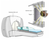 Stereotactic Radiosurgery
